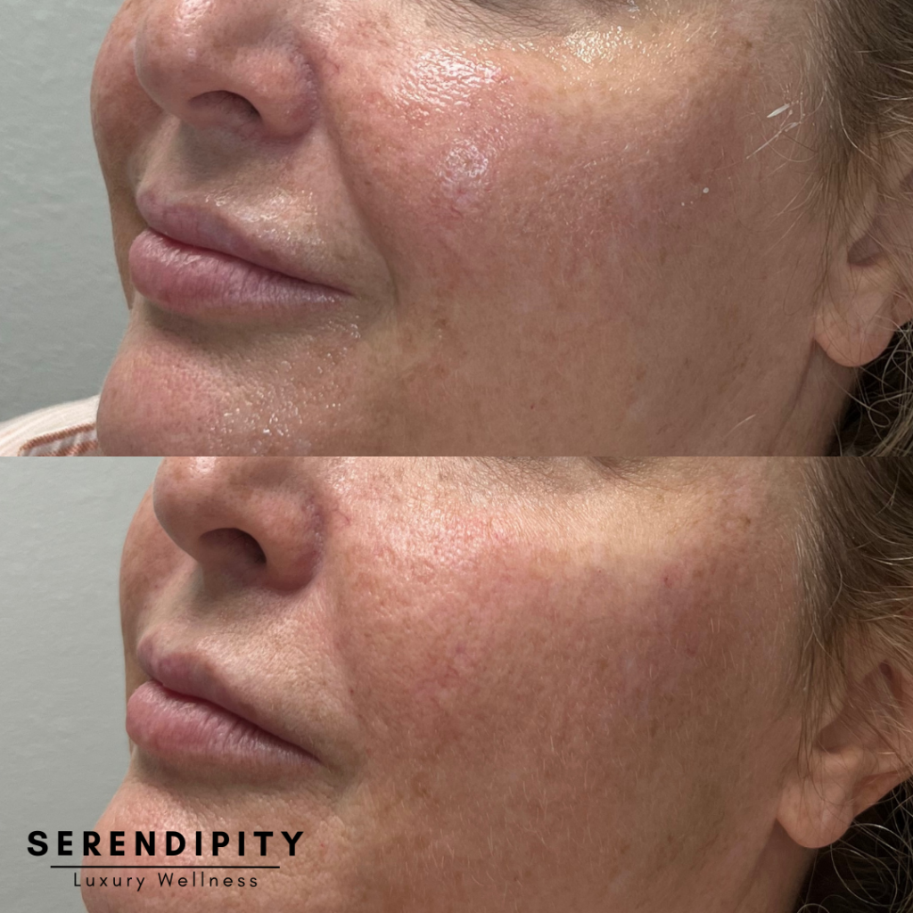 Dermal Fillers Before & After - Folds