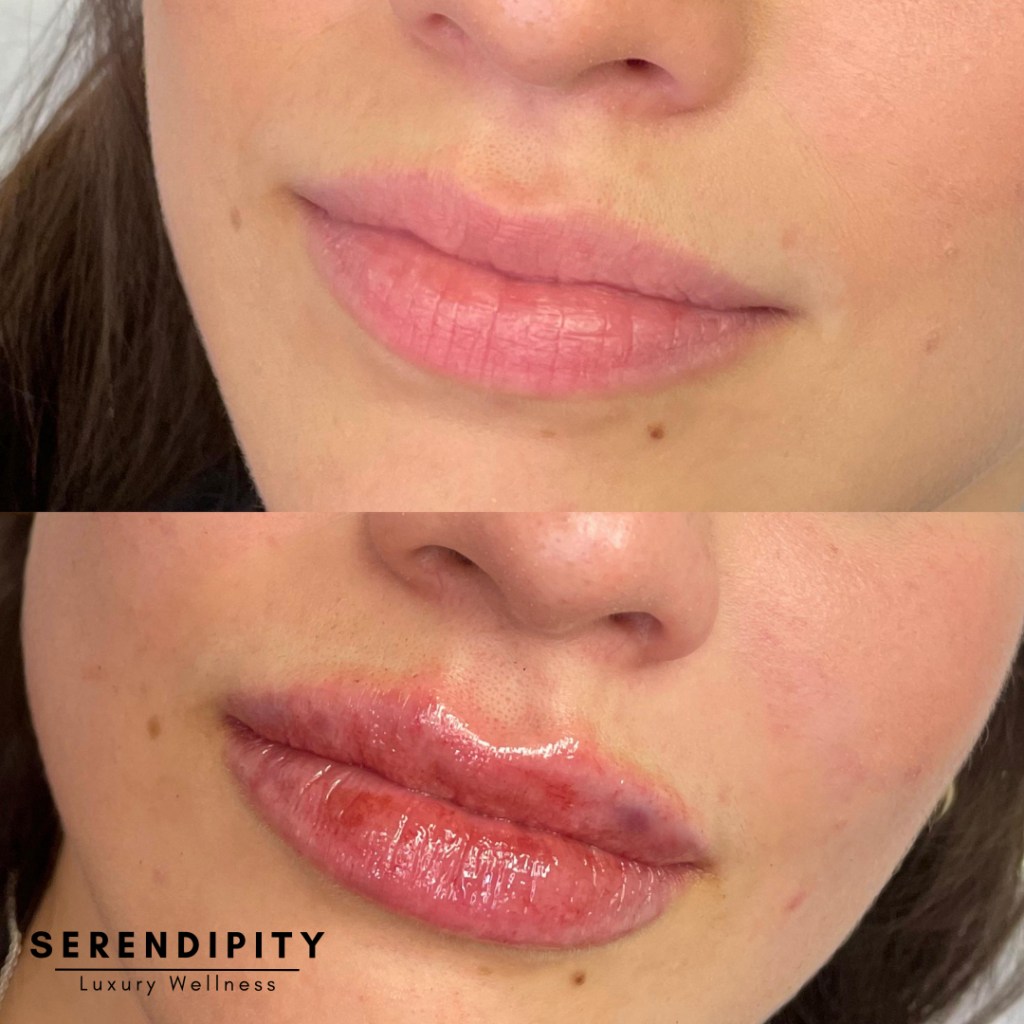 Dermal Fillers Before & After - Lips