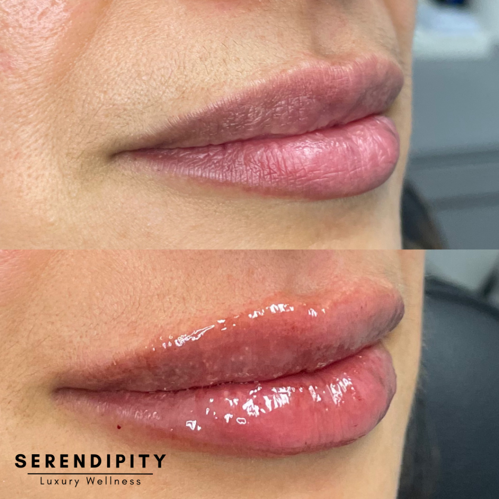 Dermal Fillers Before & After - Lips