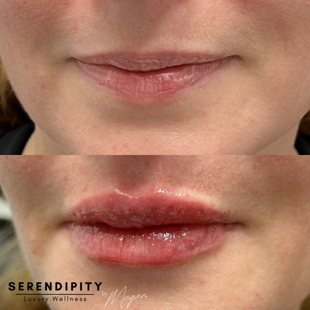 Dermal Fillers Before & After - Lips