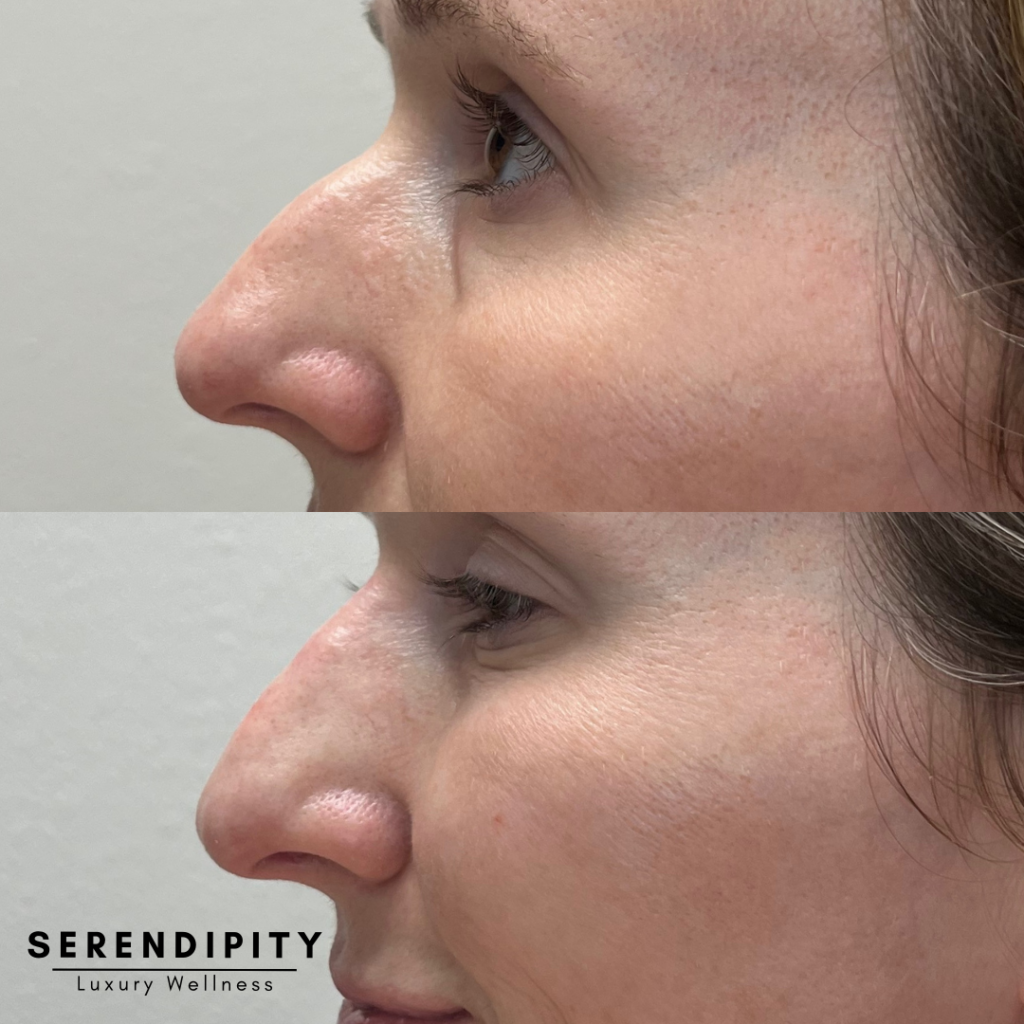 Dermal Fillers Before & After - Nose