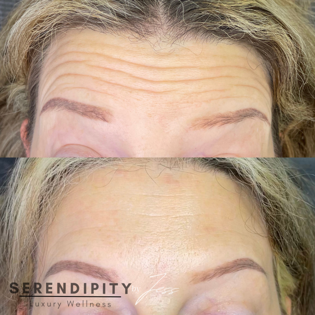 Botox Before & After - Forehead