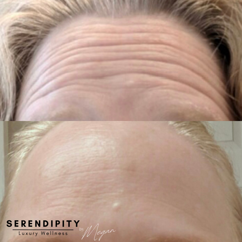 Botox Before & After - Forehead