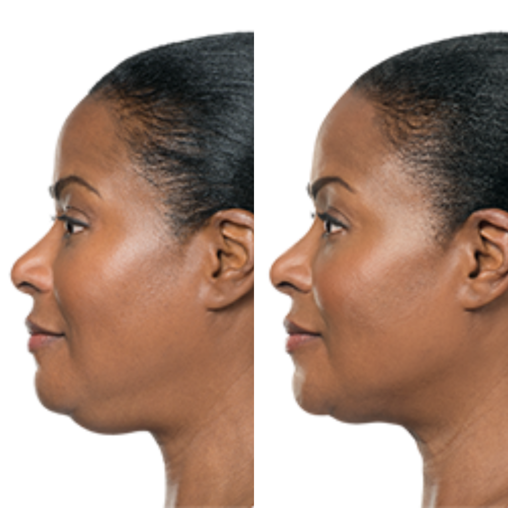 Kybella Before & After