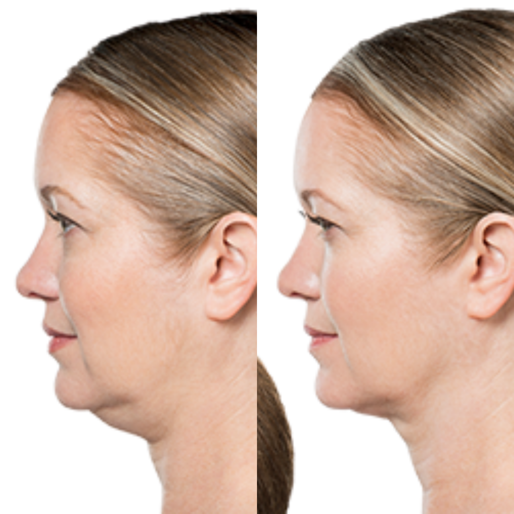 Kybella Before & After