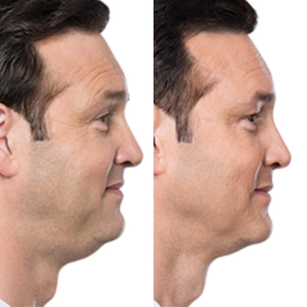 Kybella Before & After