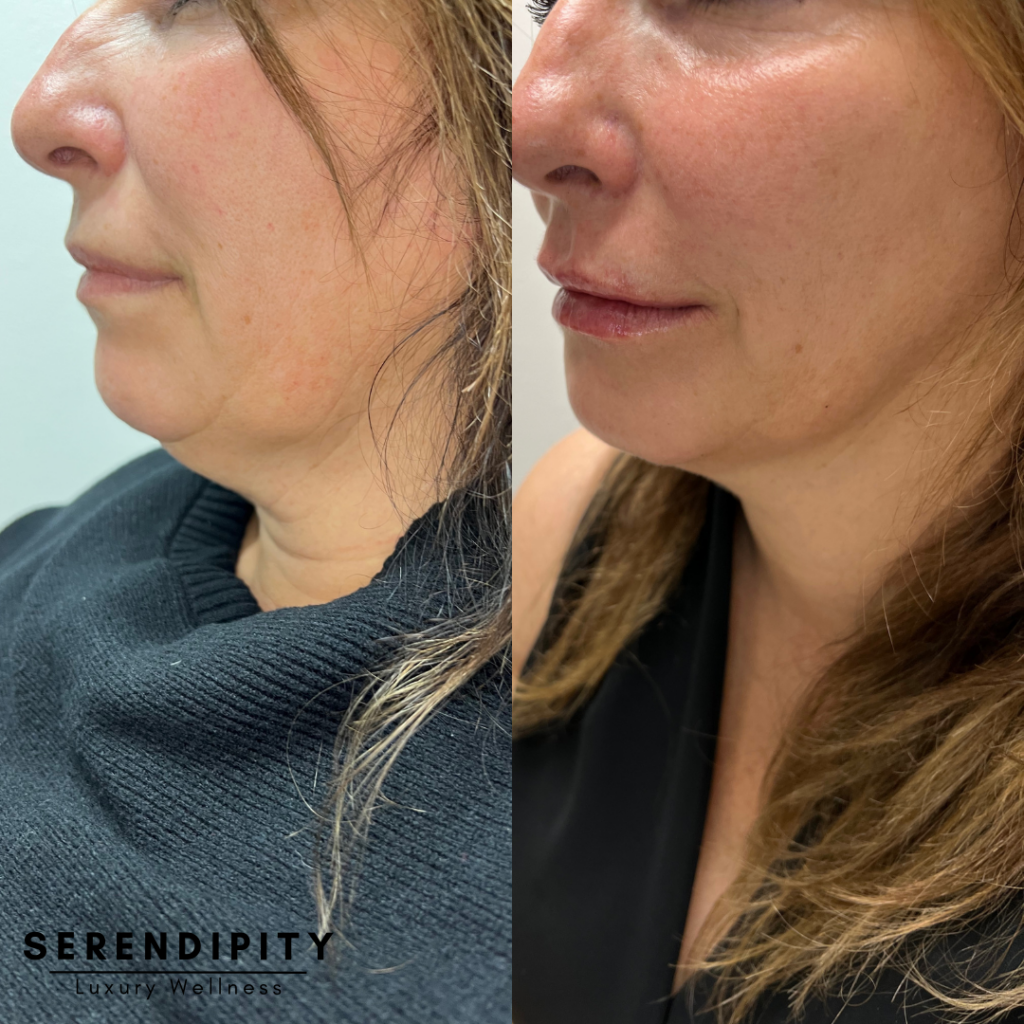 Kybella Before & After