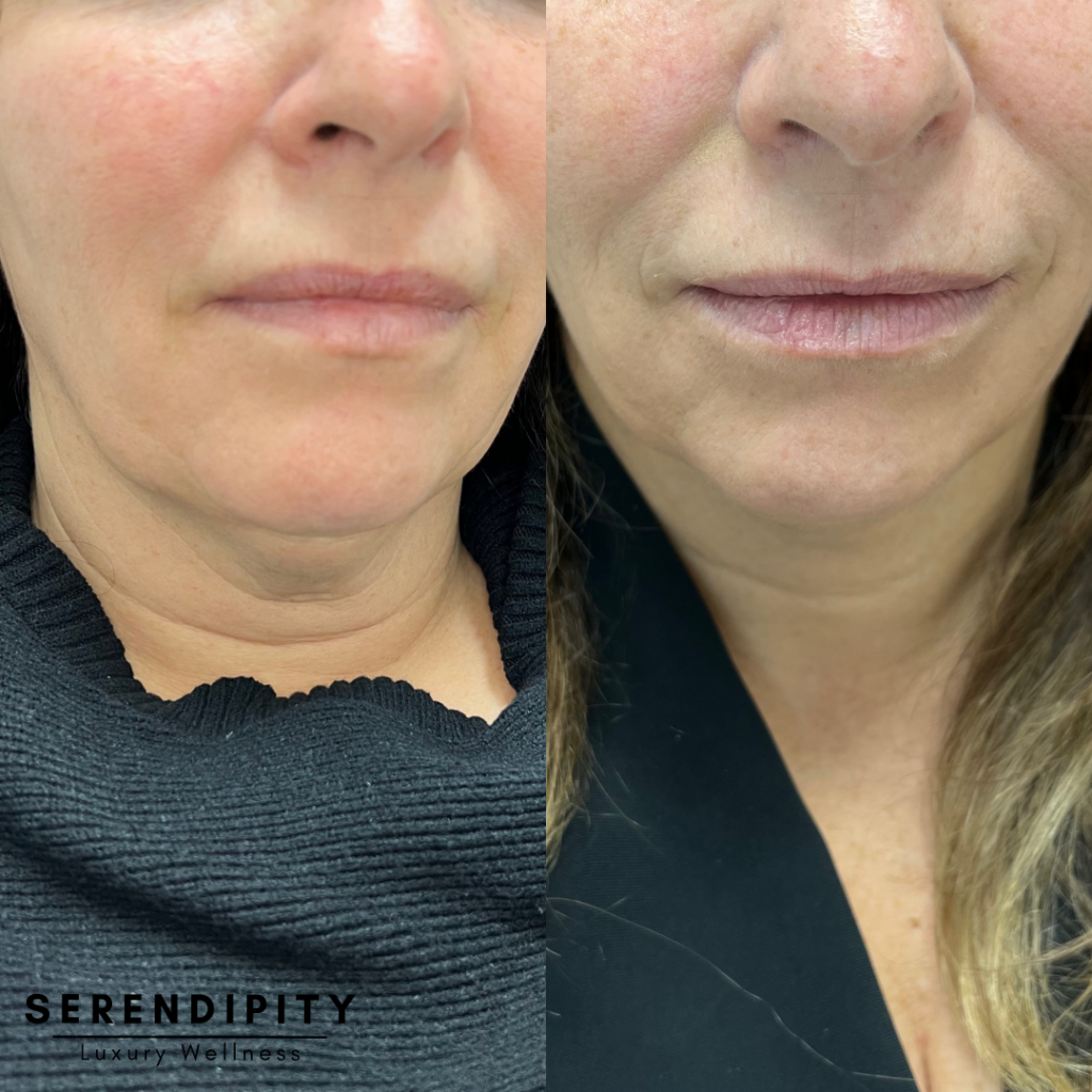 Kybella Before & After