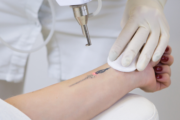 Close-up of laser tattoo removal from woman hand.