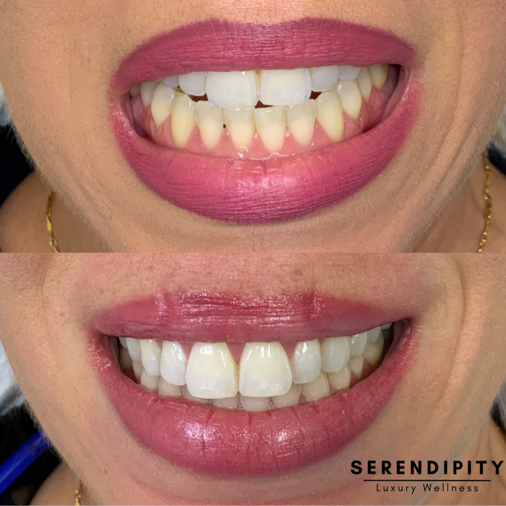 Teeth Whitening Before and After