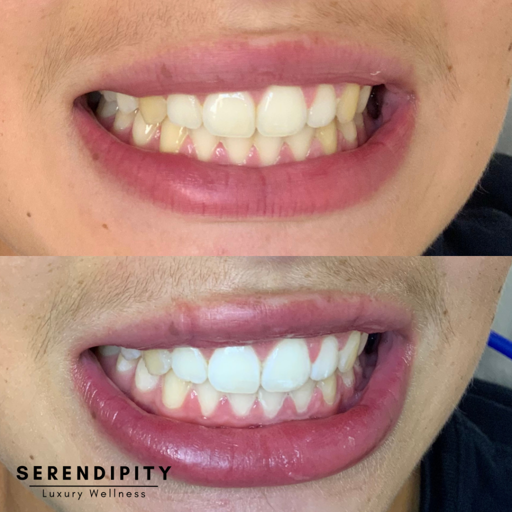 Teeth Whitening Before & After