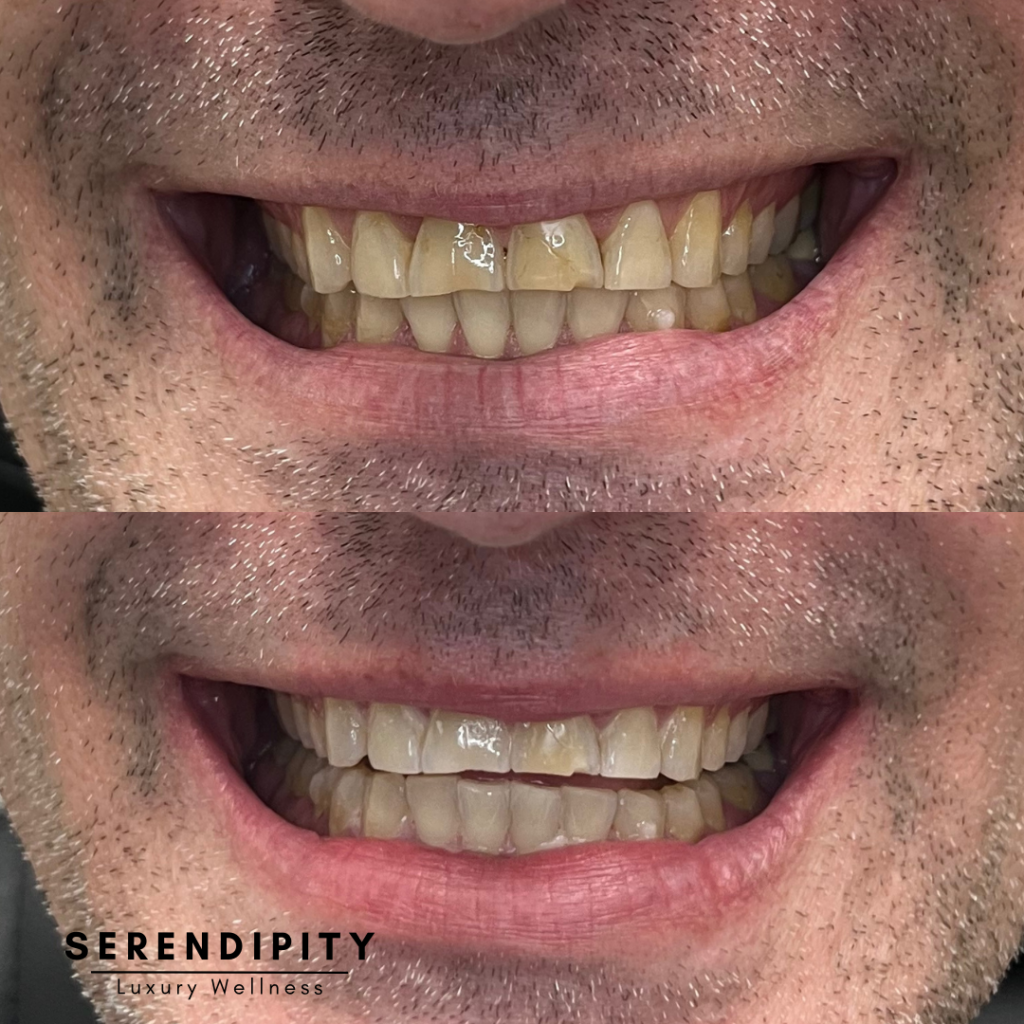 Teeth Whitening Before & After