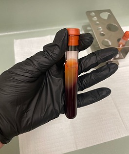 Layer of fat to be injected during PRP / PRF Treatment