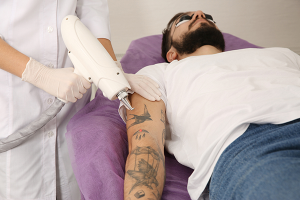 Young man undergoing laser tattoo removal procedure